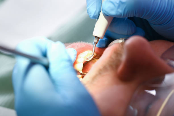 Best Emergency Root Canal Treatment in Tavares, FL